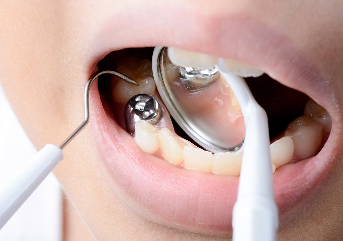 Removing mercury fillings from root canal teeth? Whole Health Dentistry