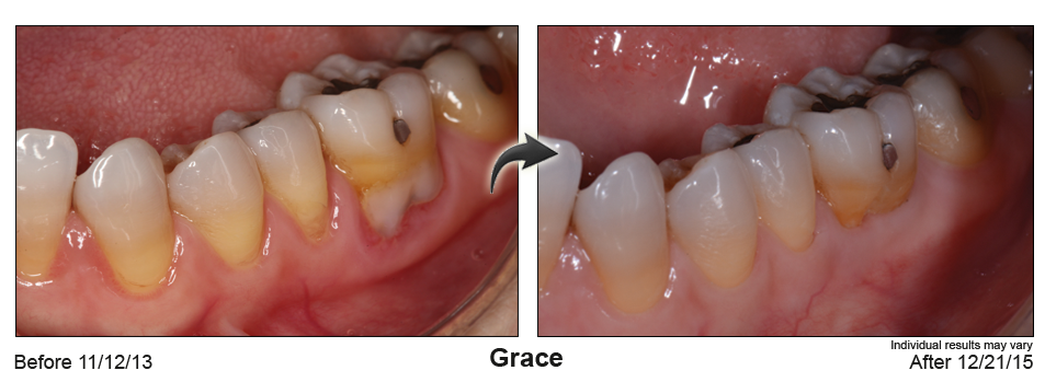 Before after case 02